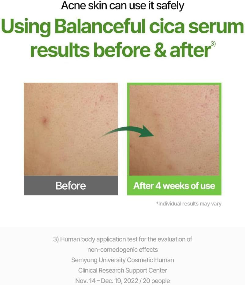 Balanceful Serum | 50Ml | Soothing, Hydrating, Gently Exfoliating Serum for Oily and Sensitive Skin, 5D Cica Complex, Centella Asiatica Extract, Korean Skincare